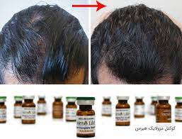کوکتل ضدریزش مو مزولایک HairMan